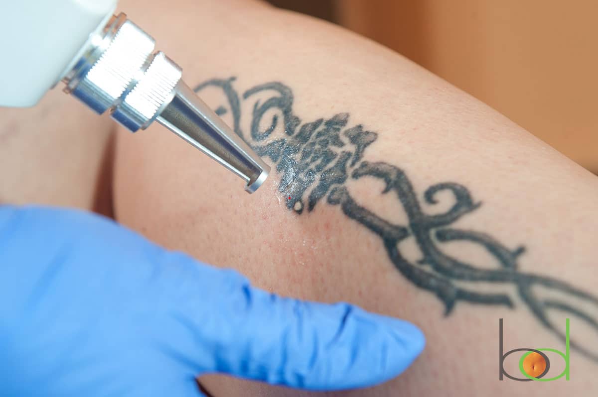 tattoo removal, laser removal