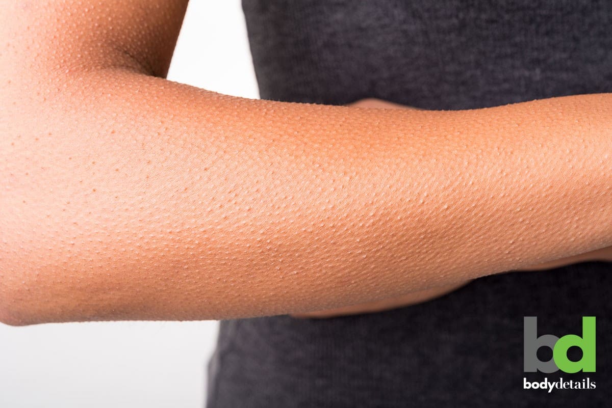 How Laser Hair Removal Can Treat Your Chicken Skin Body