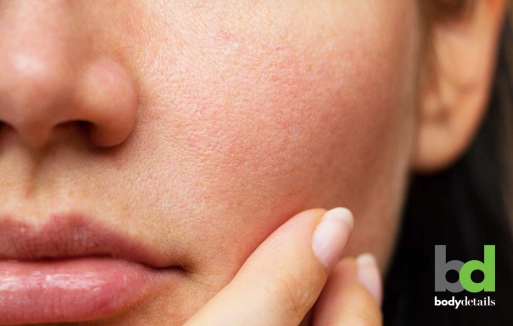 acne treatment, enlarged pores