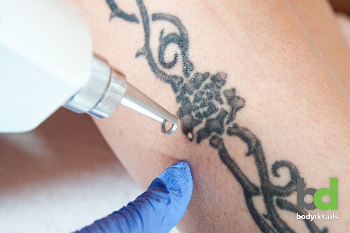 How to Prepare for Your Laser Tattoo Removal Session