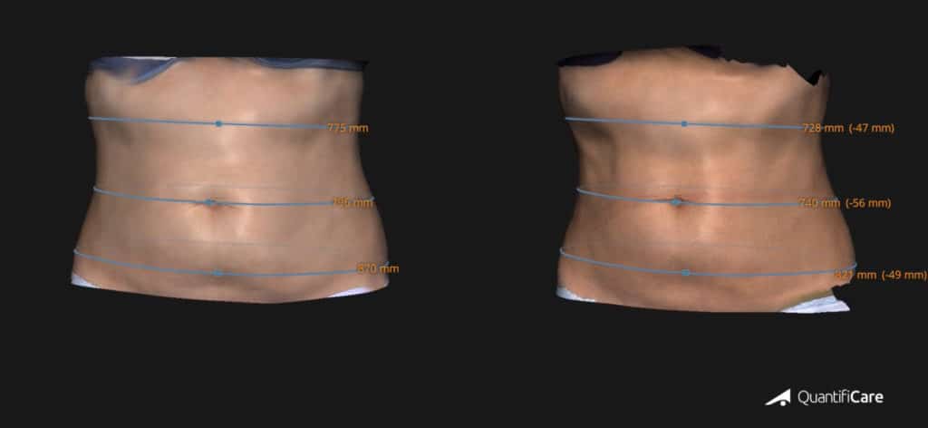 fat reduction before & after