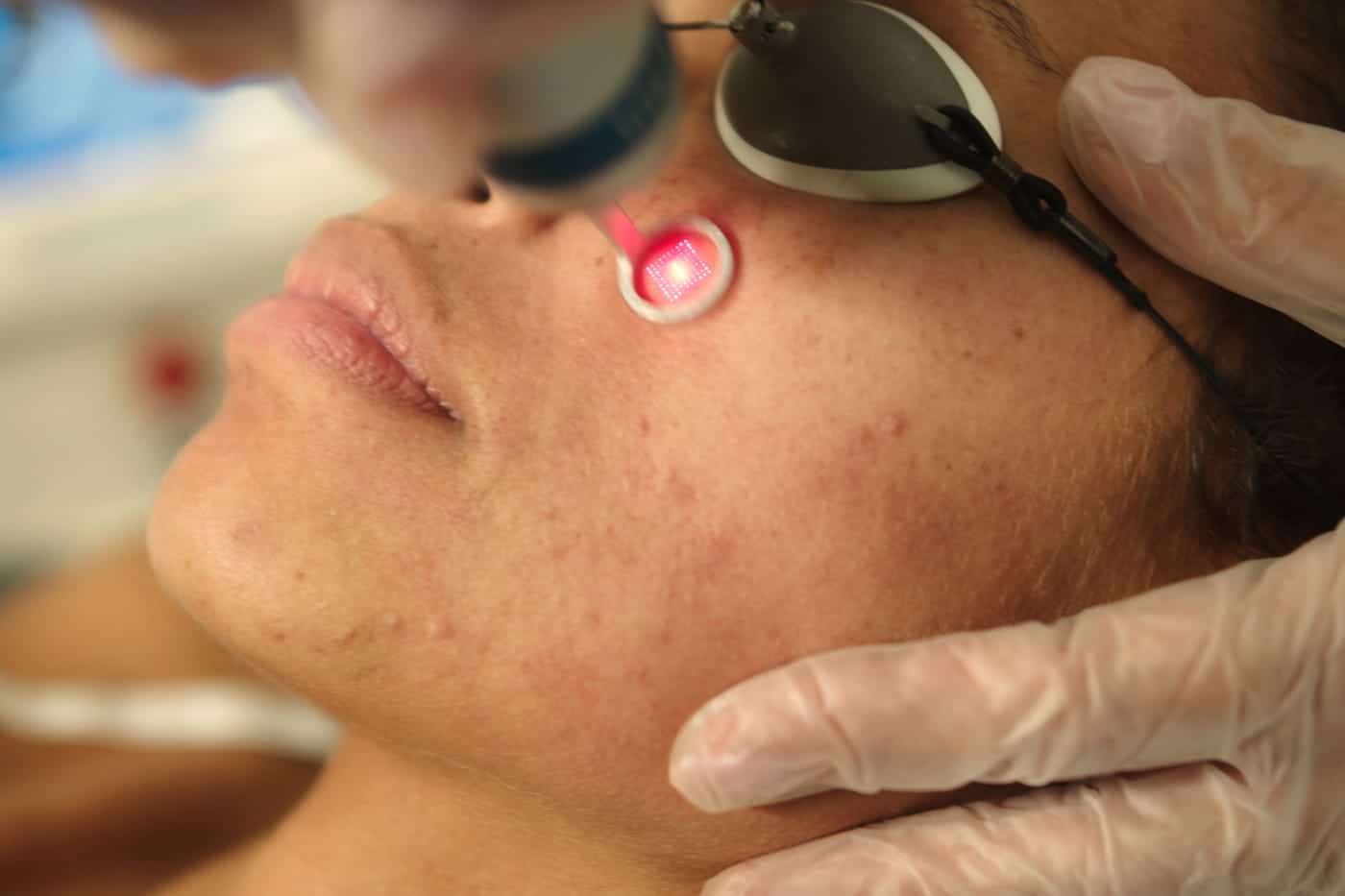 woman with acne scars getting laser skin rejuvenation treatment on her face