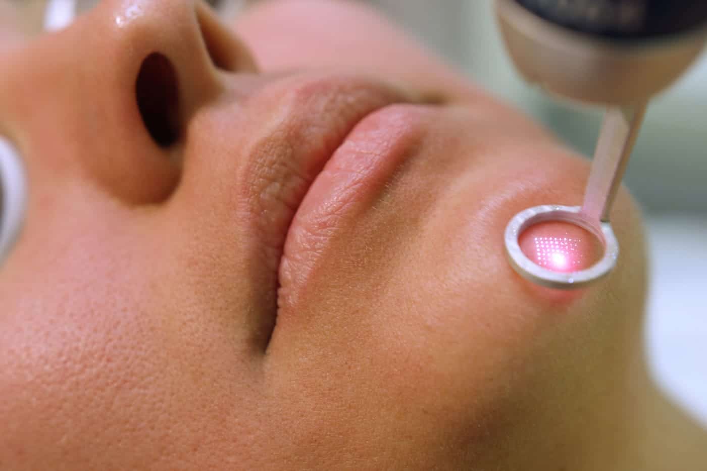 close up of woman receiving photofacial treatment